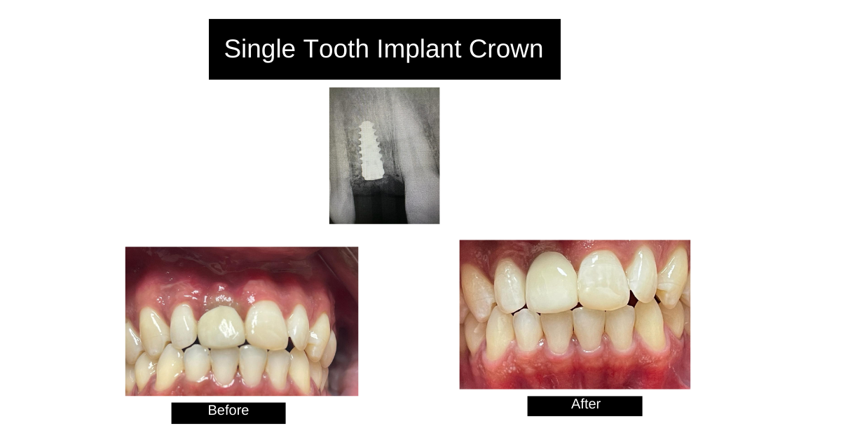 Dental Implants Nassau, Bahamas The Bahamas center for Gum Diseases